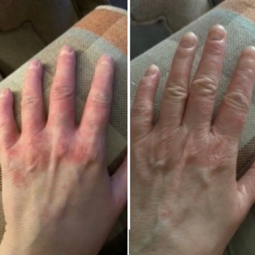 Click to view full screen Crema Dermatitis & Piel Sana – Alivia picor, enrojecimiento y descamación 50ml photo review