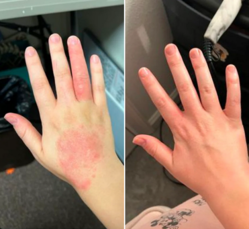 Click to view full screen Crema Dermatitis & Piel Sana – Alivia picor, enrojecimiento y descamación 50ml photo review